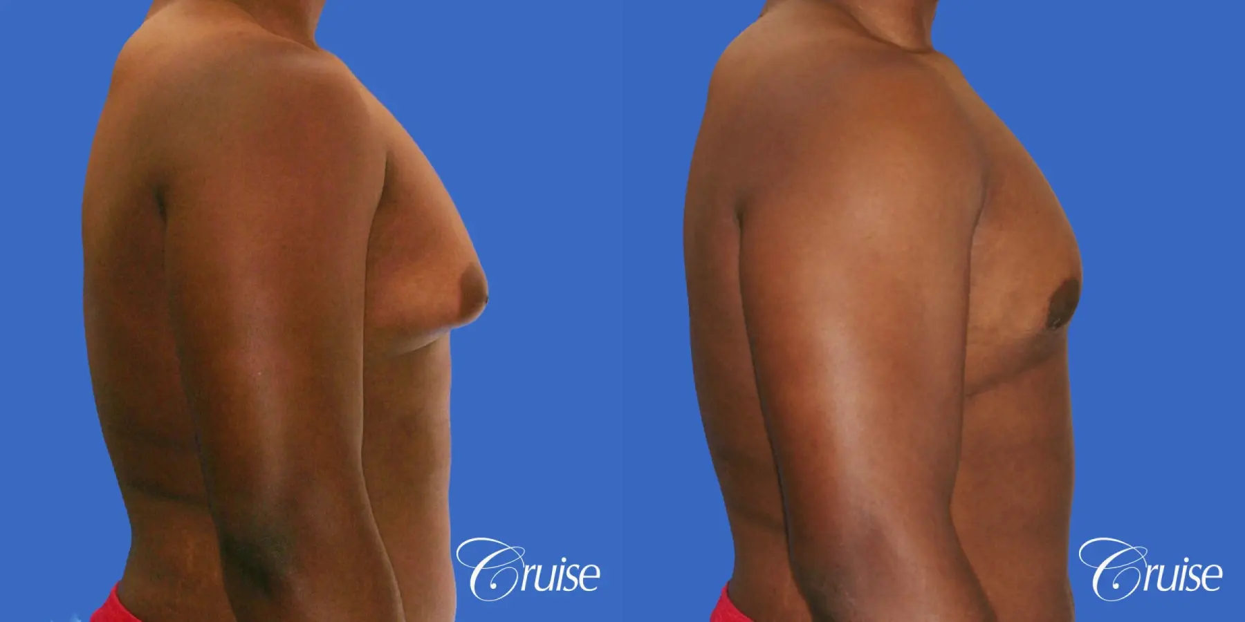 male breast moderate gynecomastia on young teen - Before and After 3