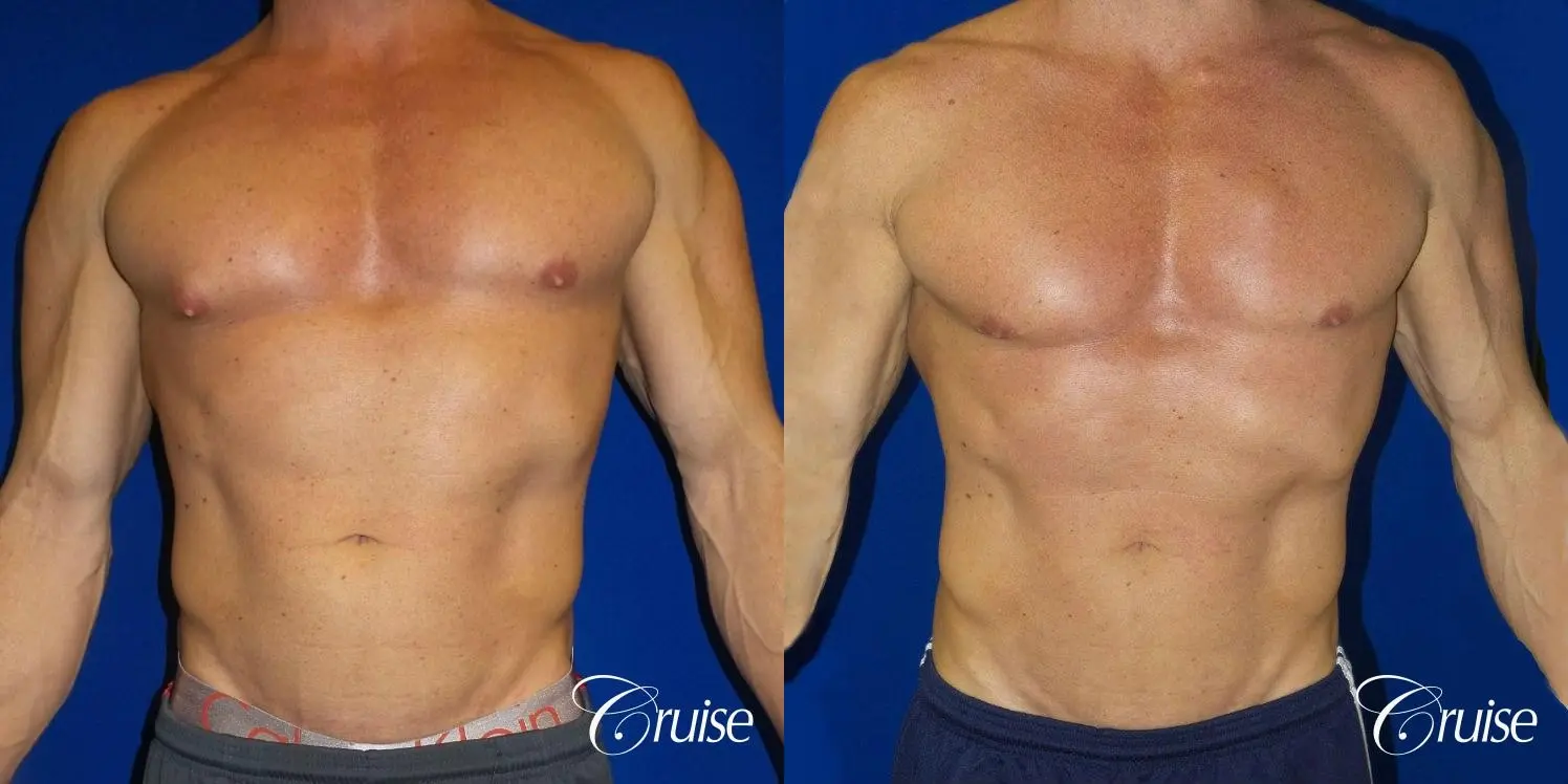 Body builder gynecomastia before and after pictures - Before and After 1
