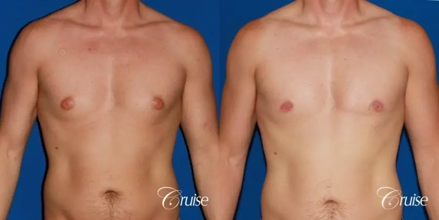 puffy nipple on 35 yr old male - Before and After 1