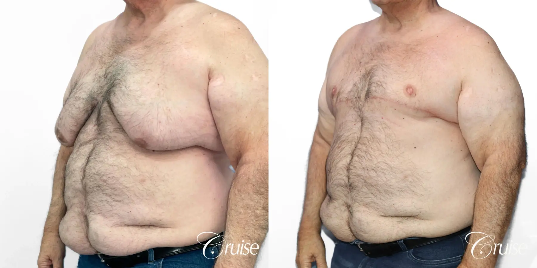 Gynecomastia: Patient 147 - Before and After 2