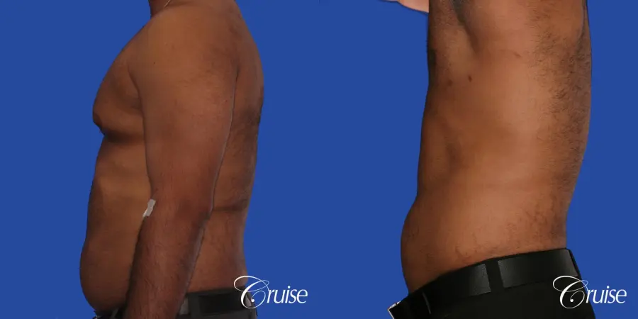 young adult with gyno gets gynecomastia surgery - Before and After 2