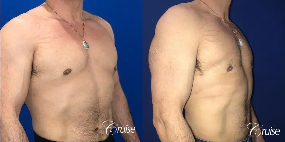 Gynecomastia: Patient 142 - Before and After 4