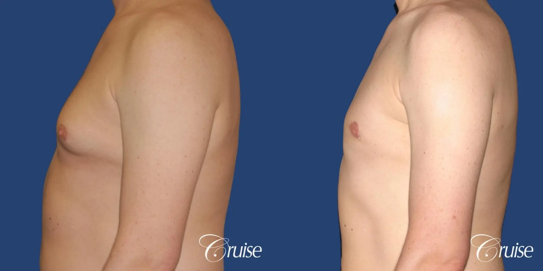moderate gynecomastia on adult with donut lift scar - Before and After 2
