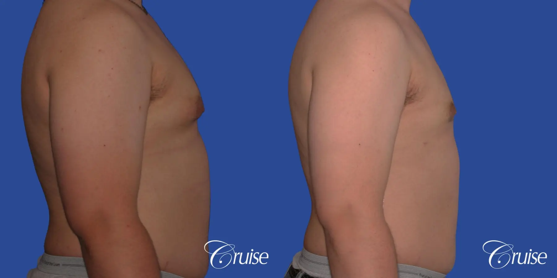 best scars for moderate gynecomastia - Before and After 3