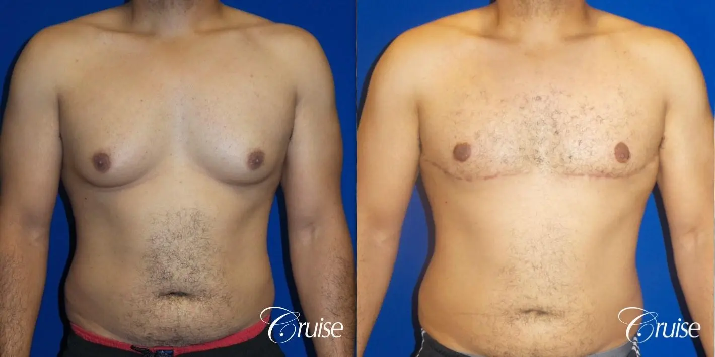 Best gynecomastia specialist in united states - Before and After 1