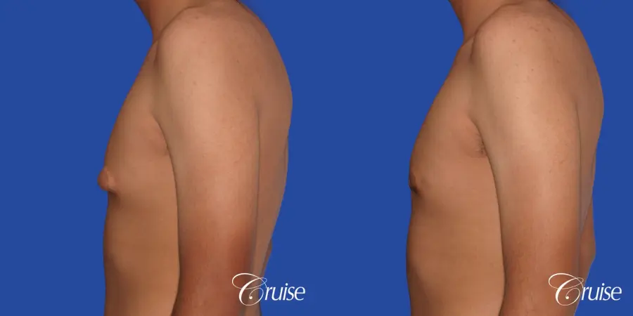 gynecomastia patient gets nipple reduction for best results - Before and After 2