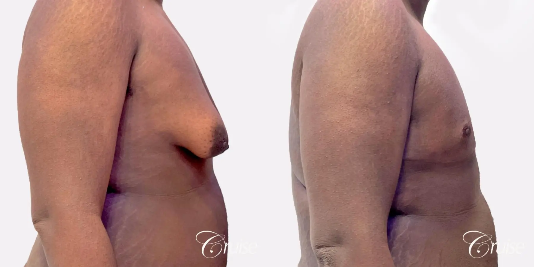Gynecomastia Type 4 - Before and After 2