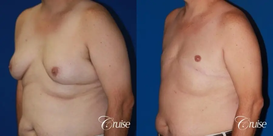 male breast severe gynecomastia free nipple graft anchor - Before and After 3