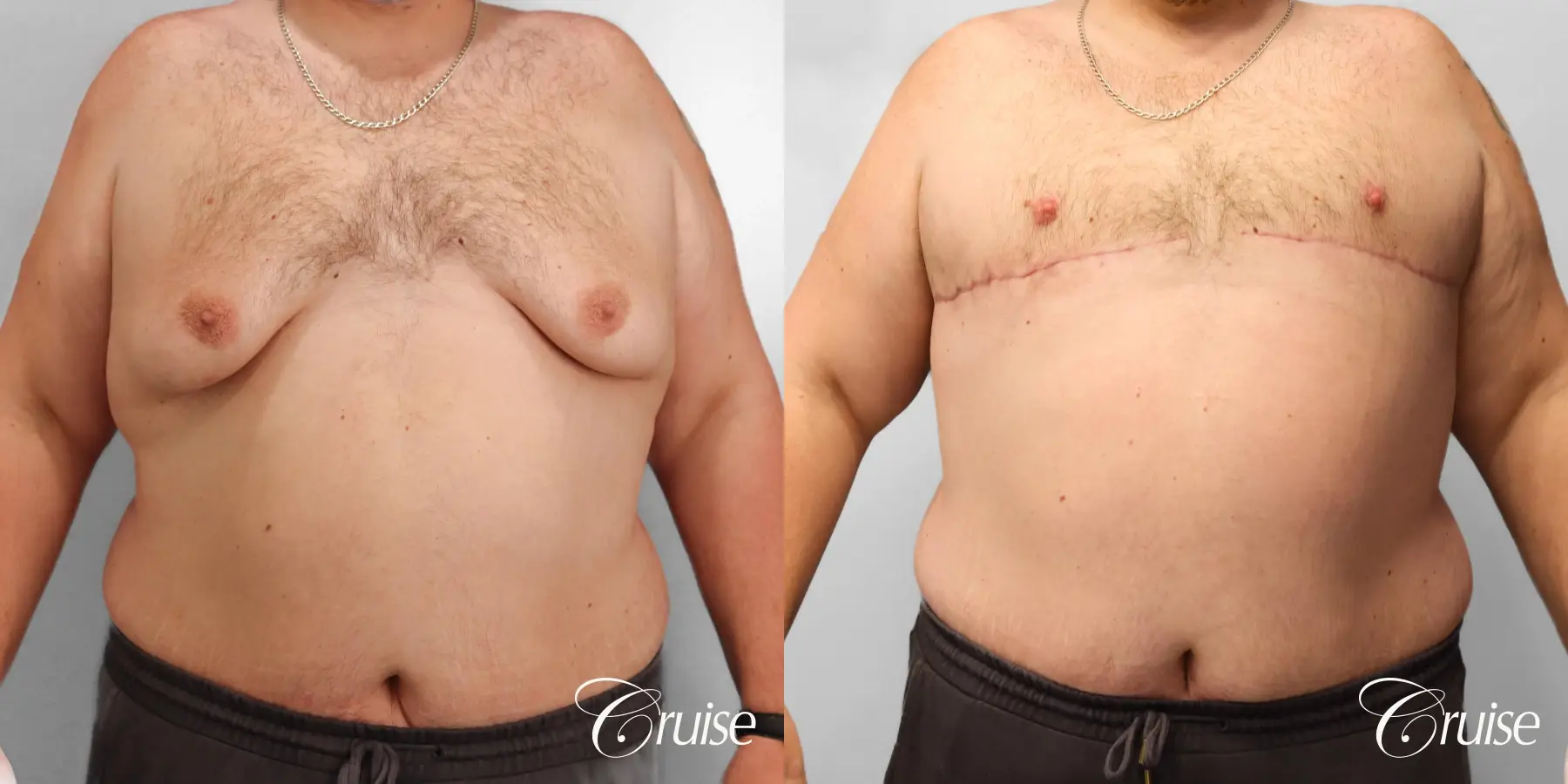 Gynecomastia: Patient 145 - Before and After 1