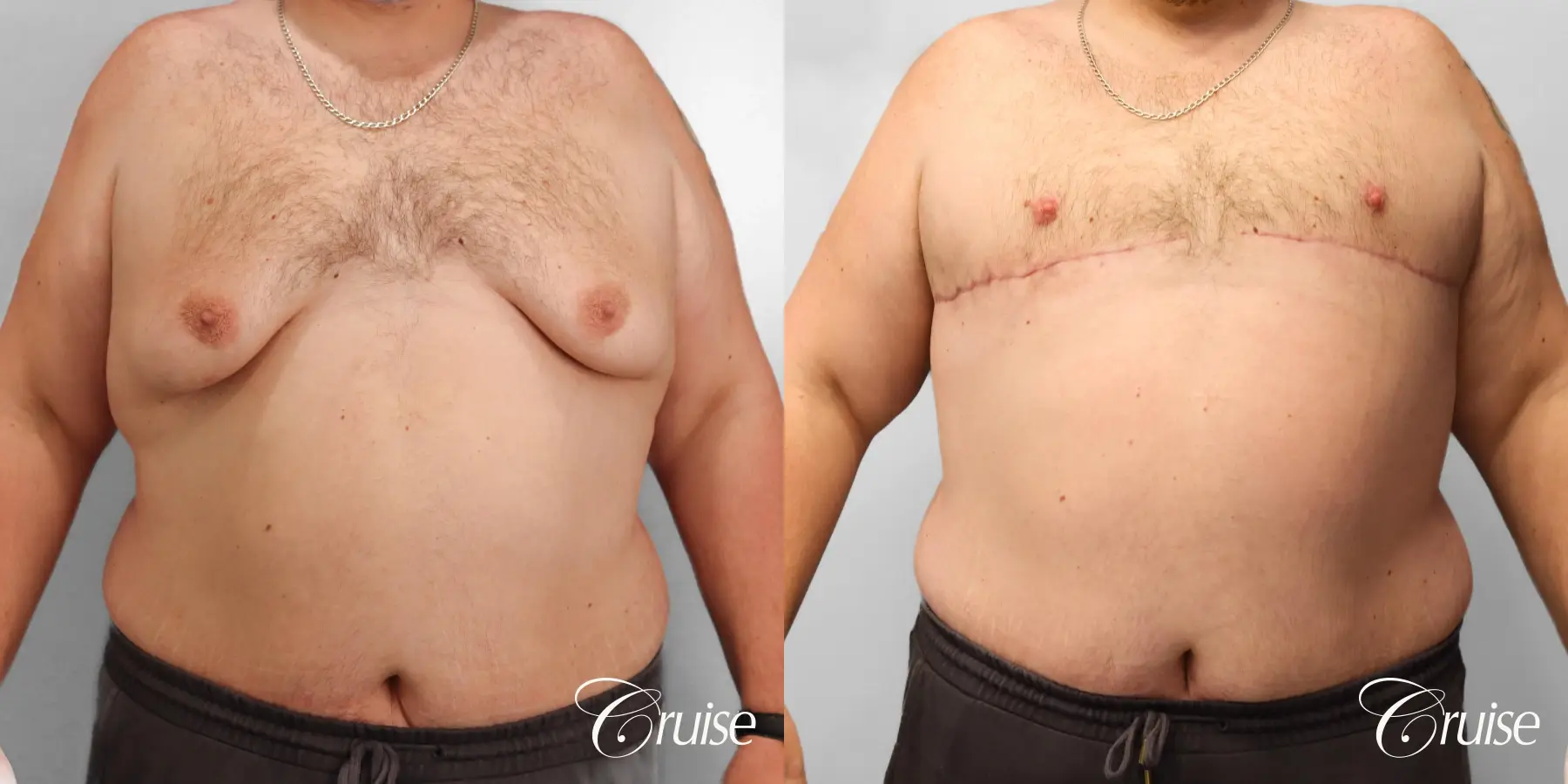 Gynecomastia: Patient 149 - Before and After 1