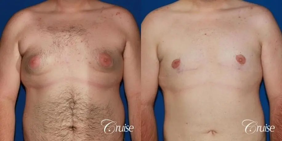 moderate gynecomastia with pointy man boobs - Before and After 1