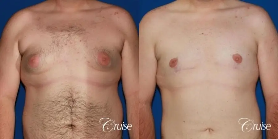moderate gynecomastia with pointy man boobs - Before and After 1