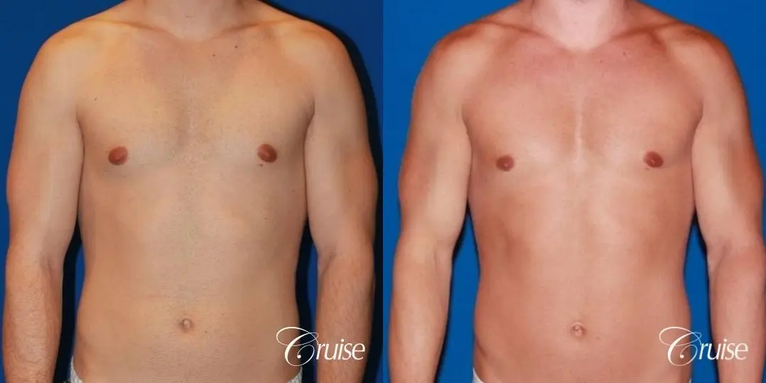 32 yo with Gynecomatia and Puffy Nipple - Before and After 1