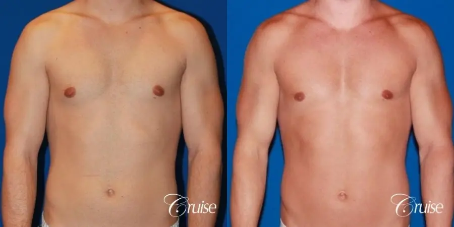32 yo with Gynecomatia and Puffy Nipple - Before and After 1