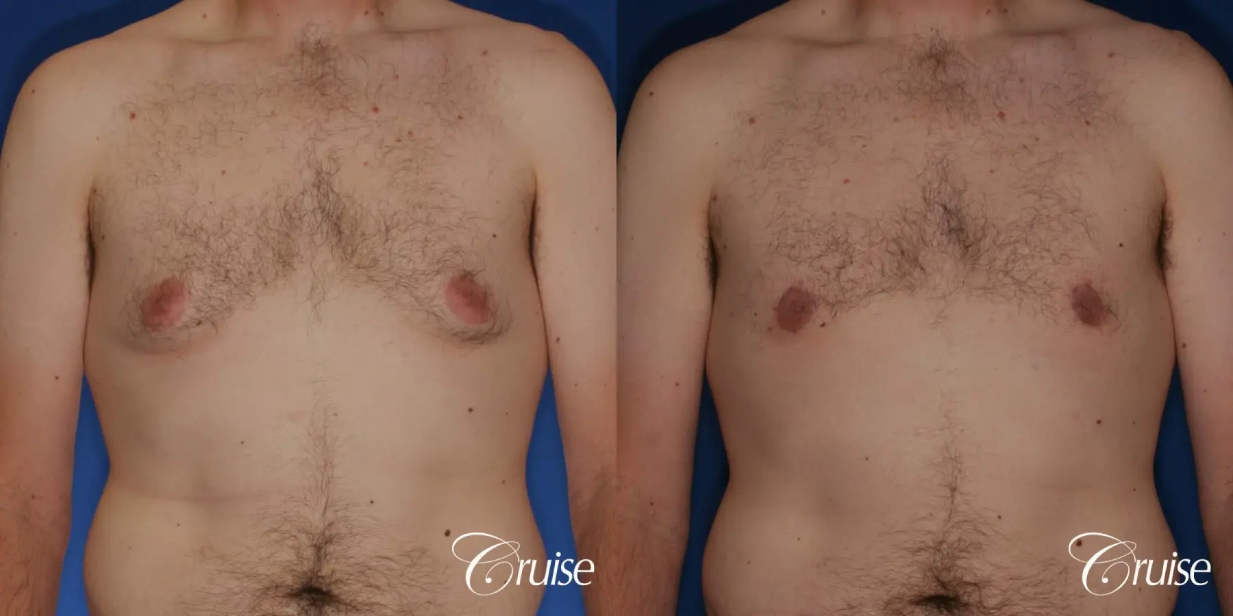 gynecomastia with skin laxity - Before and After 1