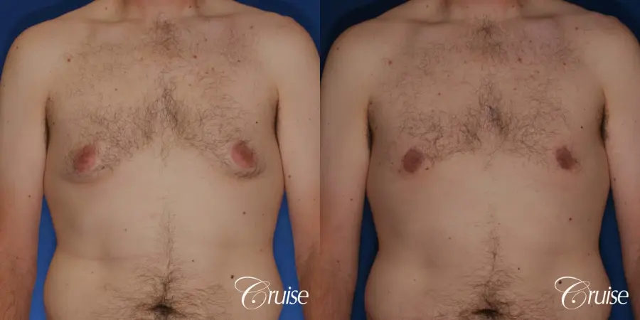 gynecomastia with skin laxity - Before and After 1