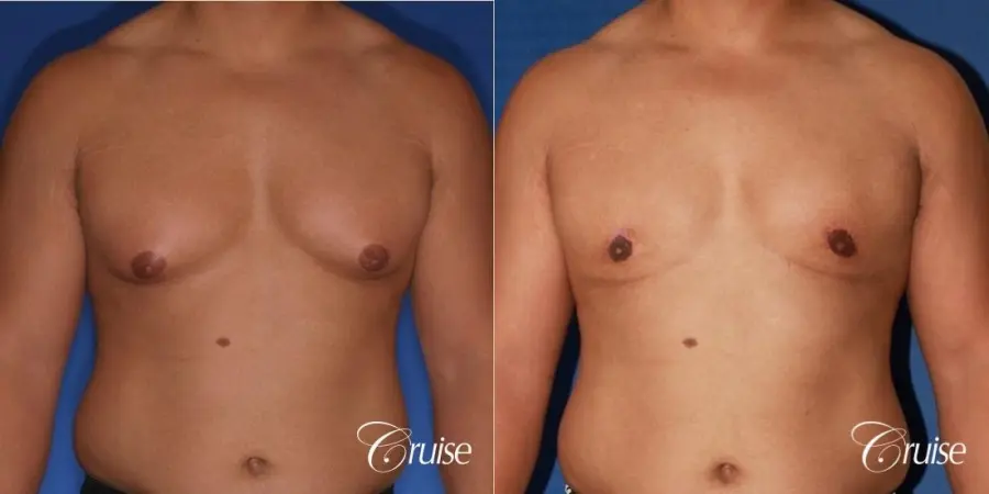 donut lift gynecomastia moderate adult - Before and After 1