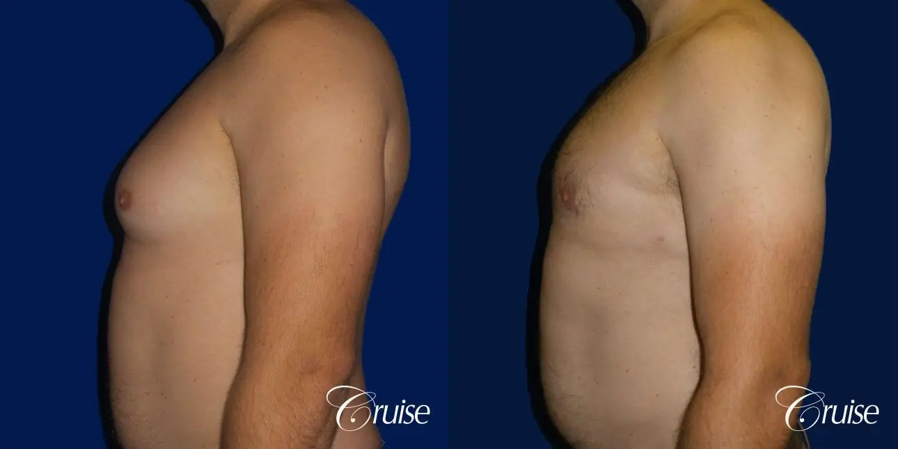 male breast reduction surgery - Before and After 3