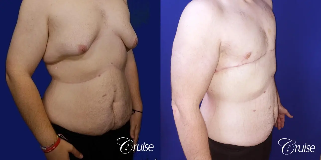 severe gynecomastia - Before and After 3
