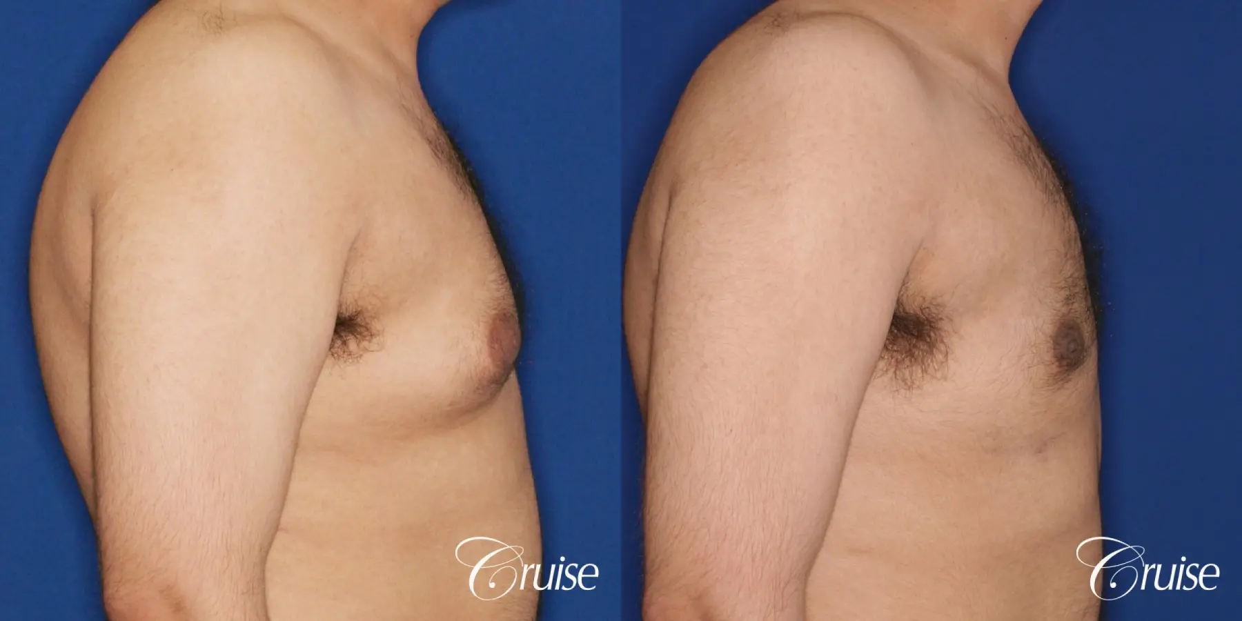 best scar on 32 gynecomastia patient - Before and After 4
