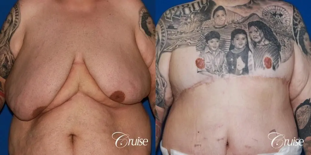 severe gynecomastia with free nipple graft on adult - Before and After 1