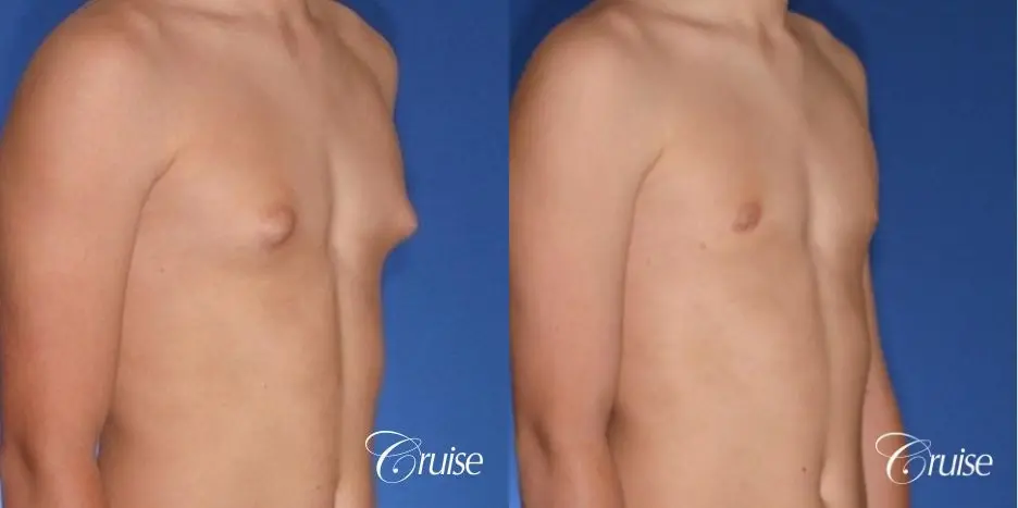 teenage gynecomastia with puffy nipple - Before and After 3