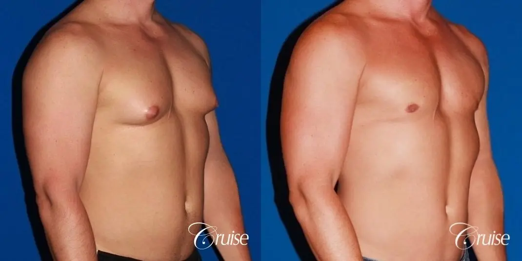 body builder with Gynecomastia puffy nipple - Before and After 4