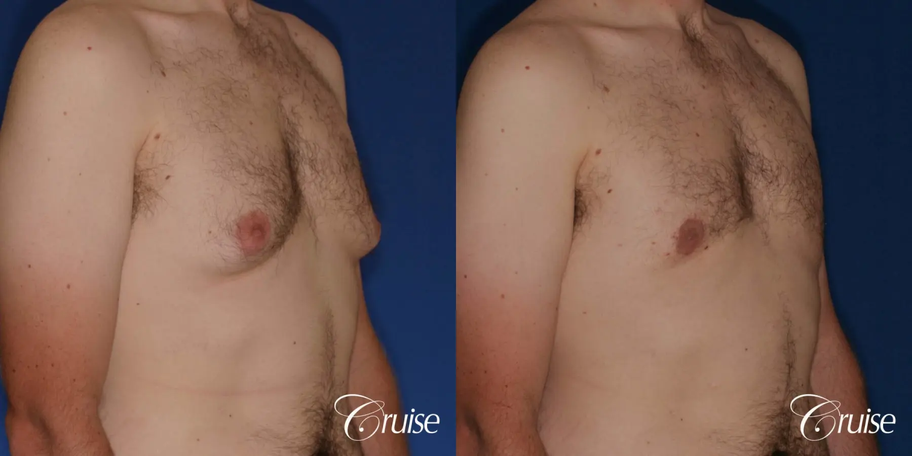 gynecomastia with skin laxity - Before and After 5