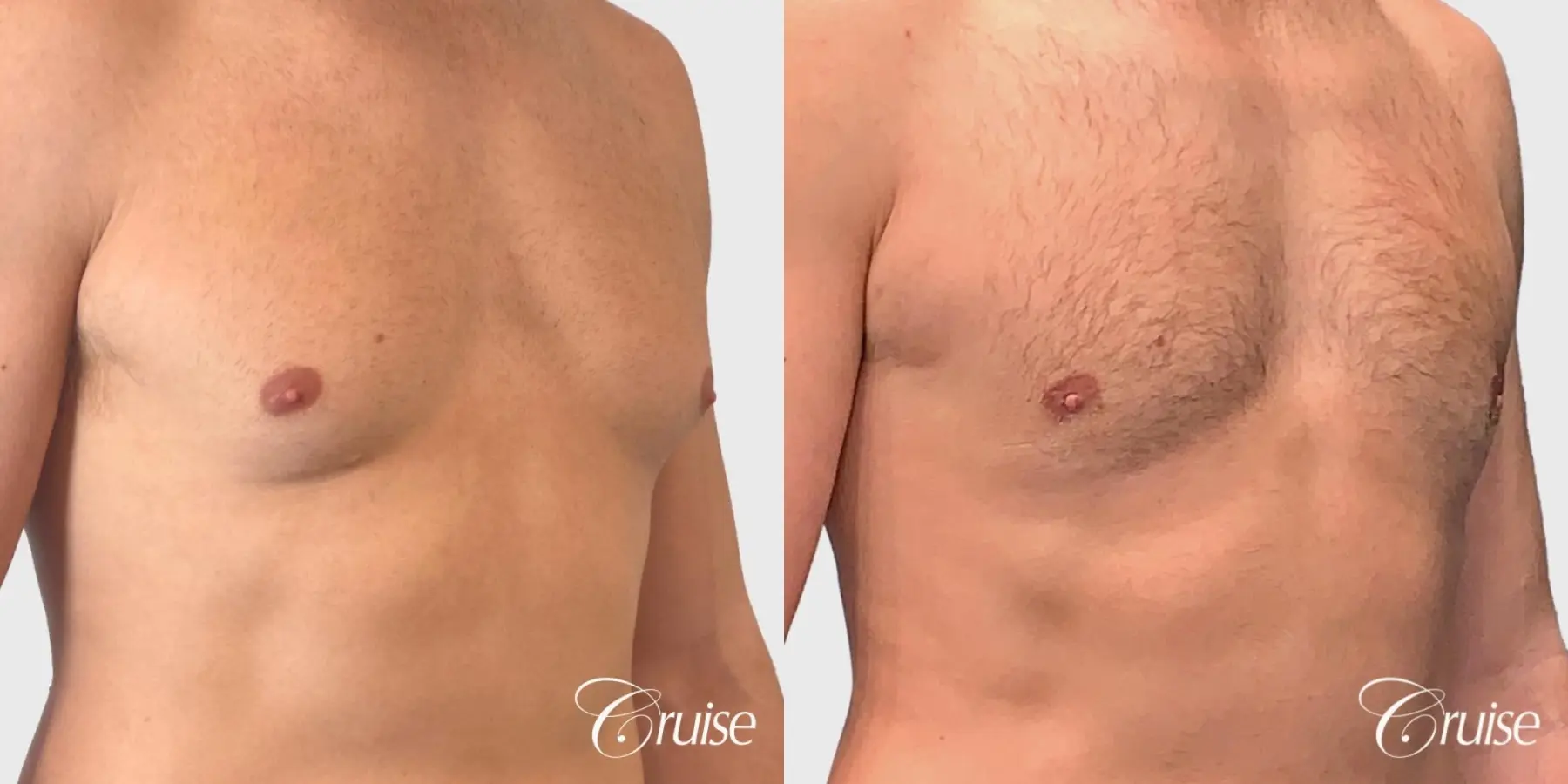 Gynecomastia Removal - Before and After 2