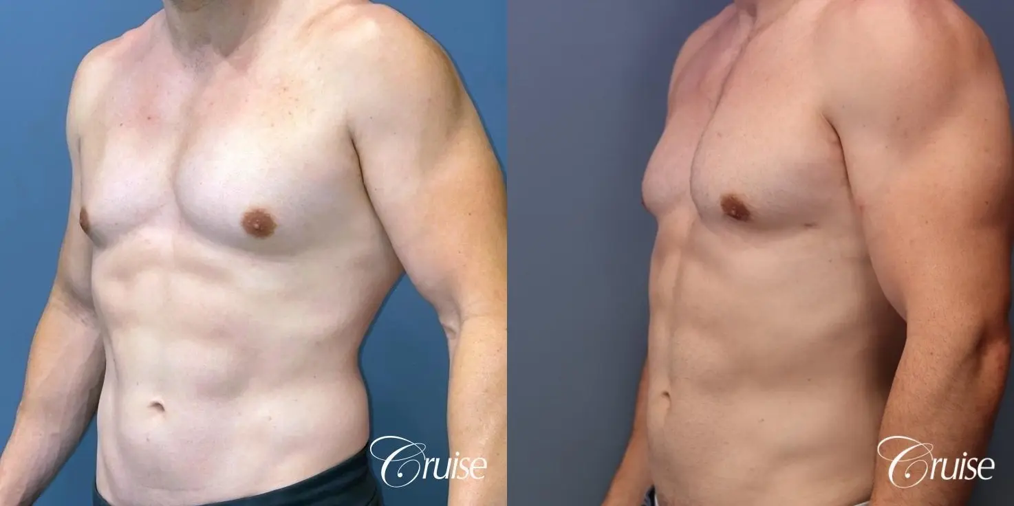 Gynecomastia: Patient 146 - Before and After 2