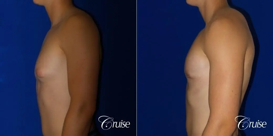 teenage gynecomastia before and afters - Before and After 5