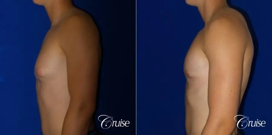 teenage gynecomastia before and afters - Before and After 5