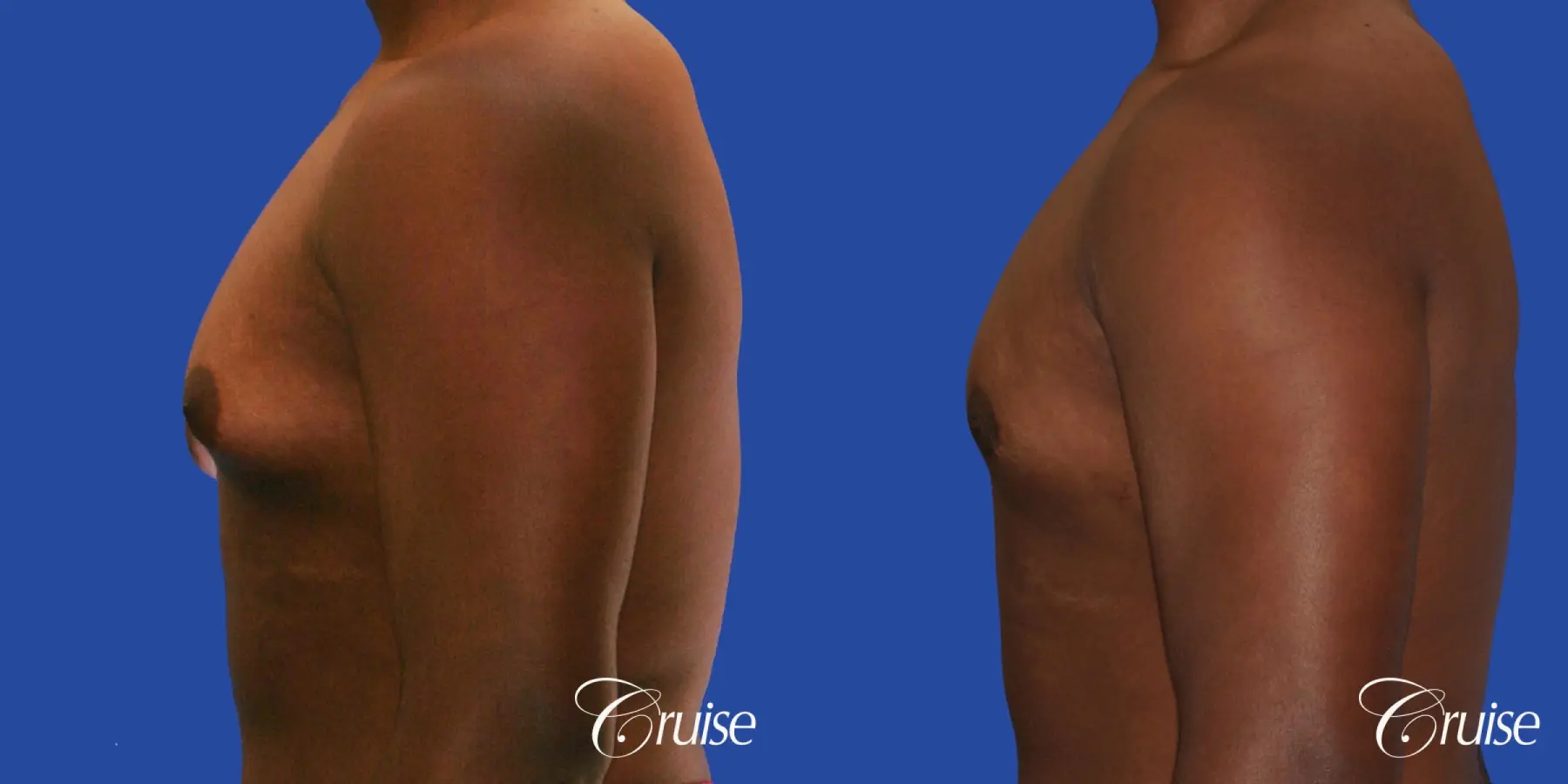 male breast moderate gynecomastia on young teen - Before and After 2