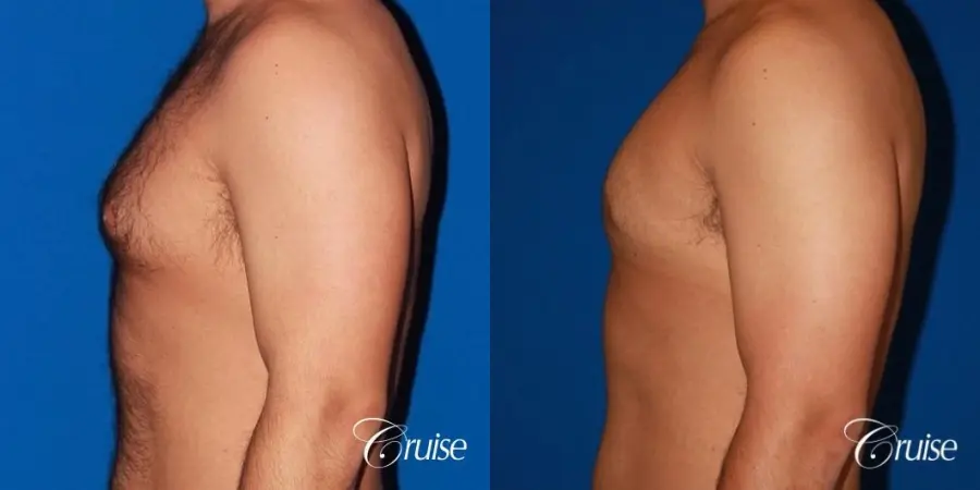 moderate gynecomastia on adult - Before and After 2
