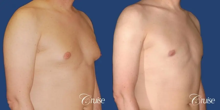 moderate gynecomastia on adult donut lift - Before and After 4