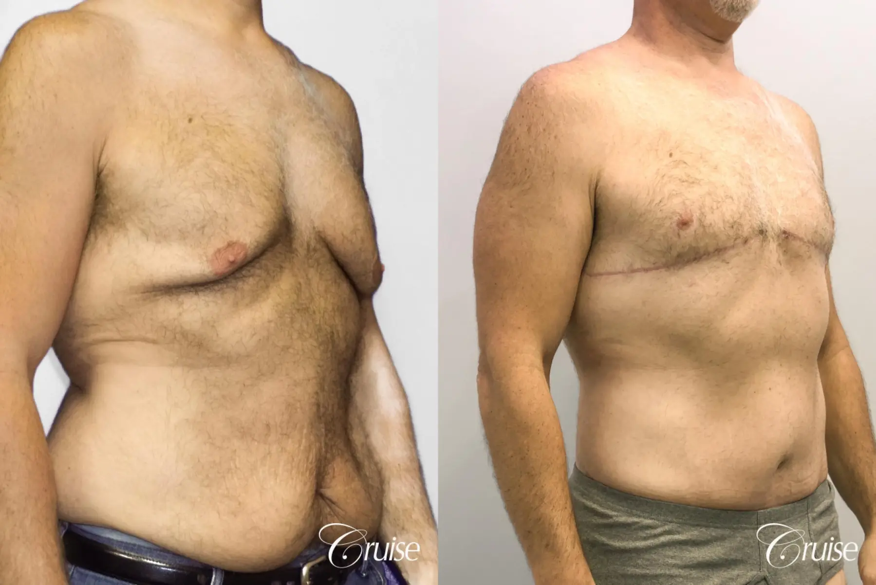 Gynecomastia: Patient 142 - Before and After 4