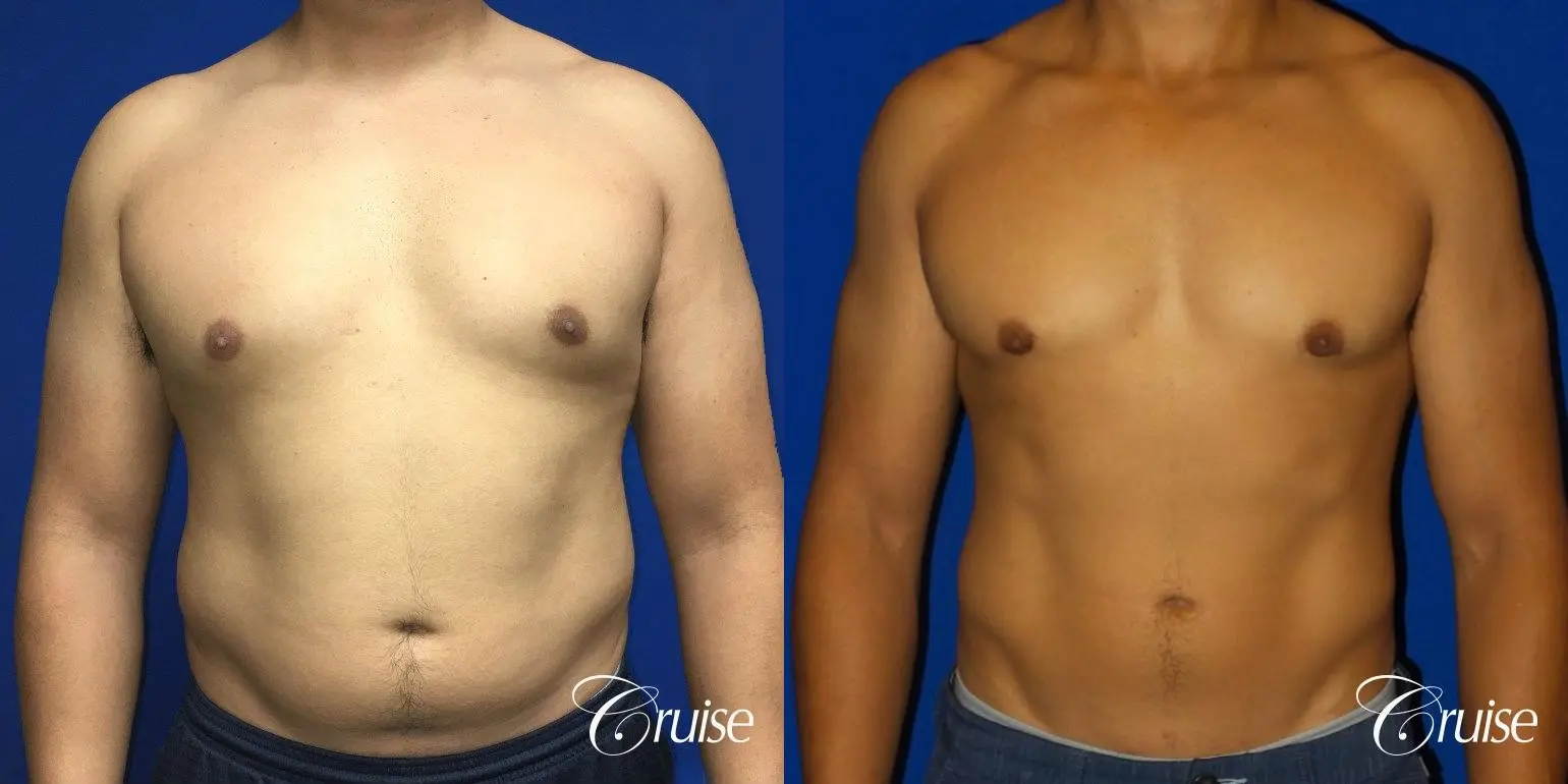 Type 2 Gynecomastia with Areola Incision - Before and After 1