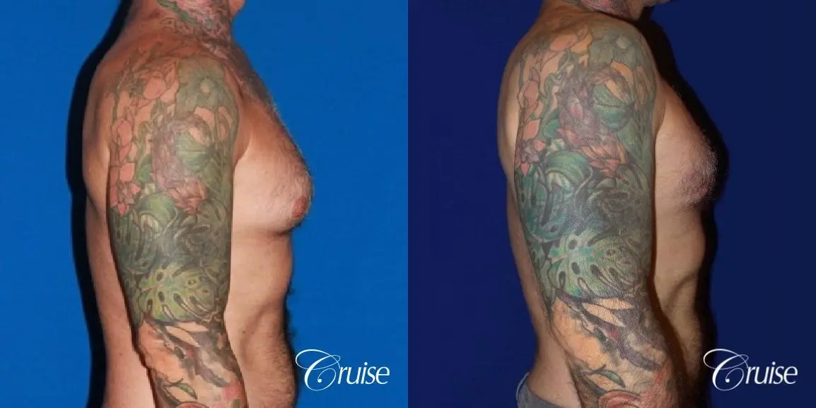 adult gynecomastia - Before and After 3