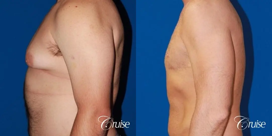 Free Nipple Graft male gynecomastia - Before and After 2
