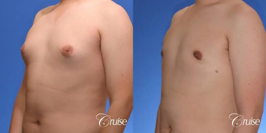 young male with mild gynecomastia surgery for puffy nipple - Before and After 3