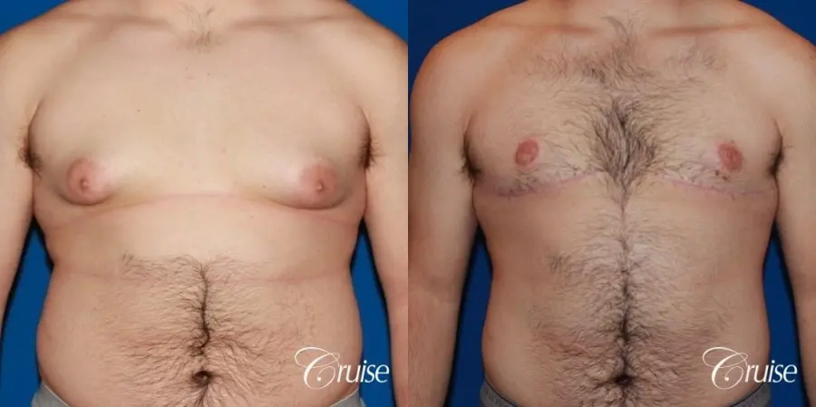 20 with Gynecomastia and puffy nipple - Before and After 1