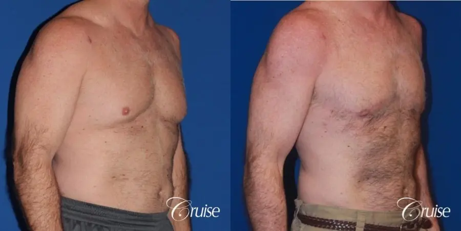 extended pa incision on gynecomastia patient - Before and After 3