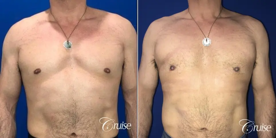 Gynecomastia: Patient 140 - Before and After 1