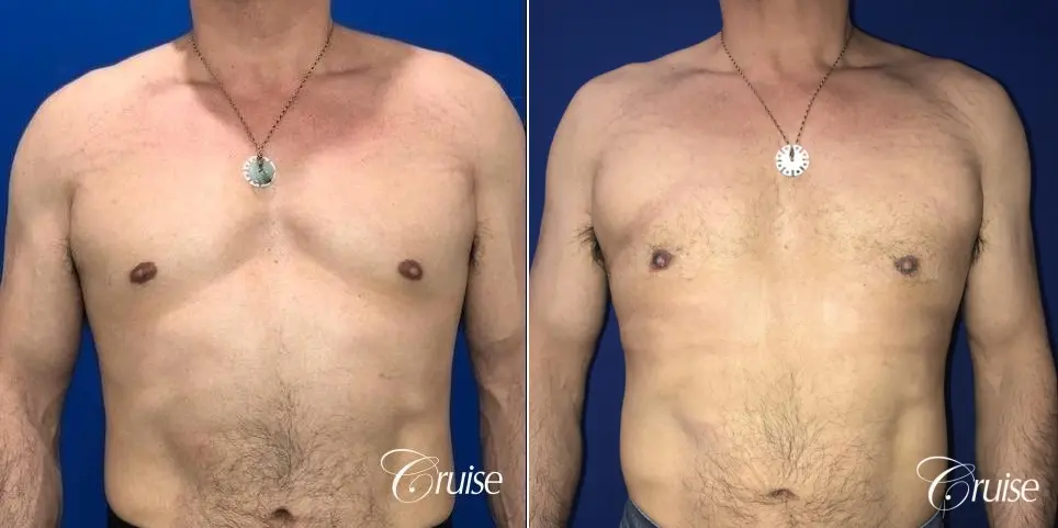 Gynecomastia: Patient 142 - Before and After 1