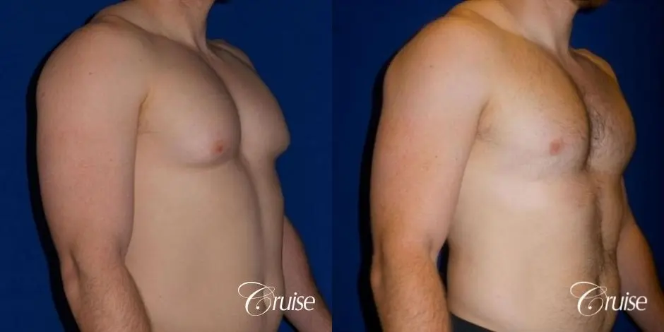 Dr. Cruise gynecomastia surgery photos - Before and After 2