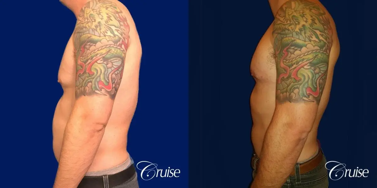 gynecomastia with skin laxity - Before and After 2