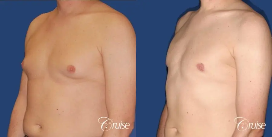 moderate gynecomastia on adult donut lift - Before and After 3