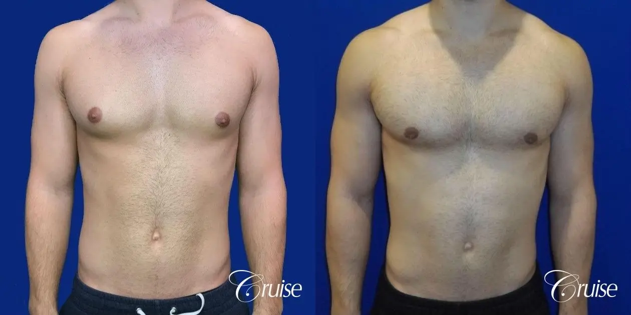 gynecomastia correction newport beach - Before and After 1