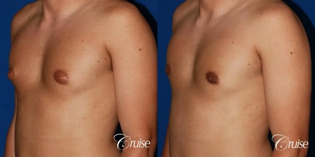 mild gynecomastia before and after with puffy nipple - Before and After 3