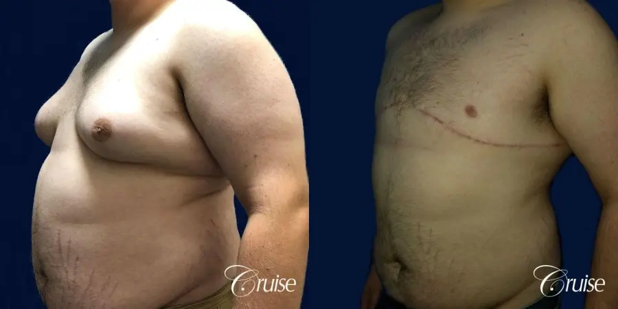male breast reduction surgery orange county - Before and After 3